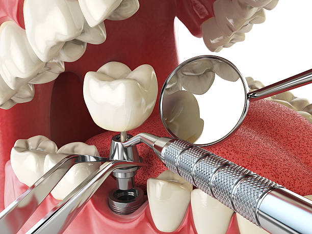 Best Emergency Tooth Extraction in Orland Hls, IL